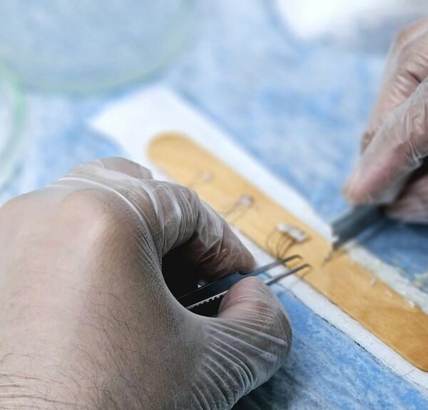 medical registry for heart transplantation alerts